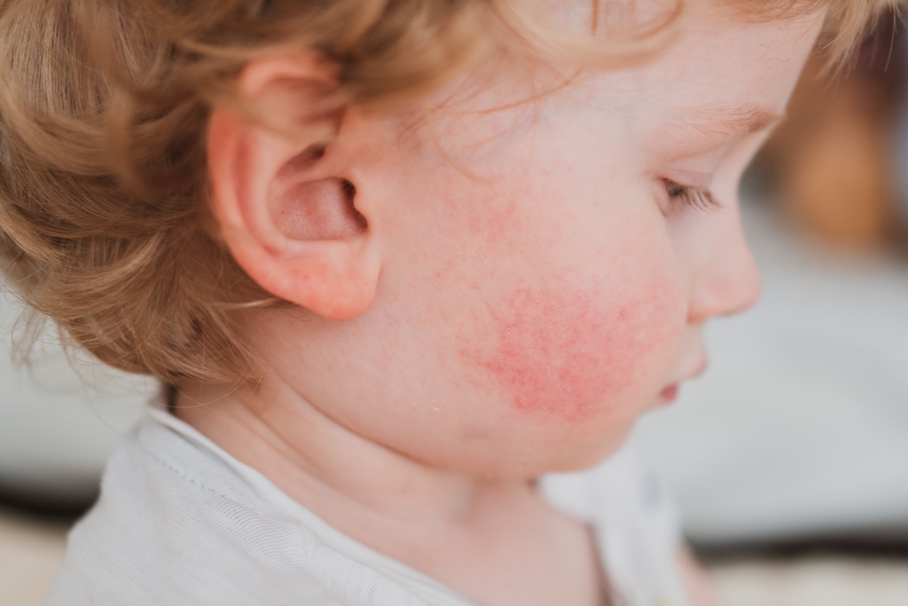 Аллергические высыпания у ребенка на коже