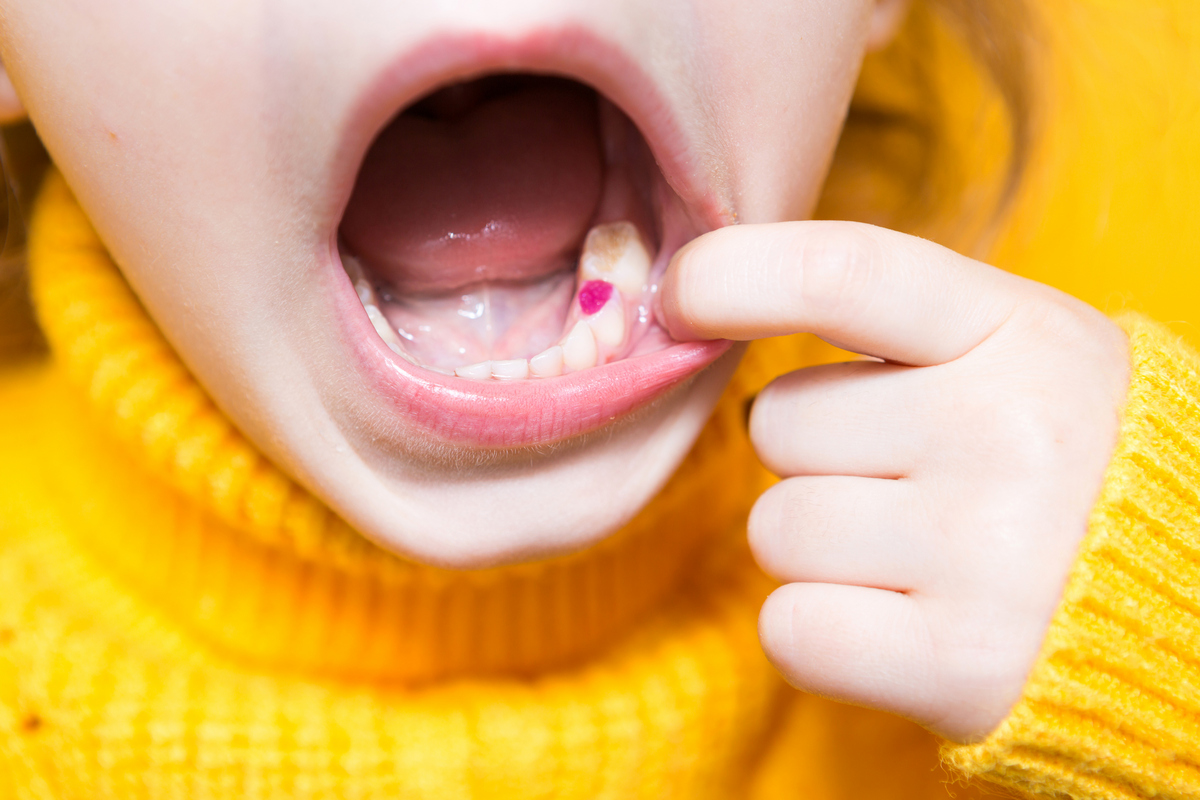 Цветная пломба на детском зубе